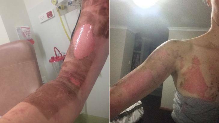 Injuries suffered by Danika Jones from a Thermomix incident. Photo: Supplied.