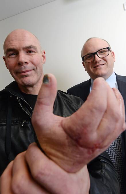 MARATHON OPERATION: Jarrod Ryan with plastic surgeon Broughton Snell. A surgical team operated for 11 hours to reattach Mr Ryan's fingers. Picture: DARREN HOWE