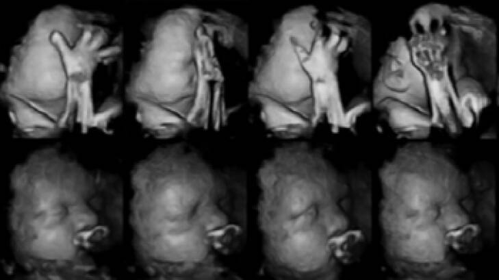 Fetuses of mothers who smoked (top row) moved their mouths and touched their faces more frequently.