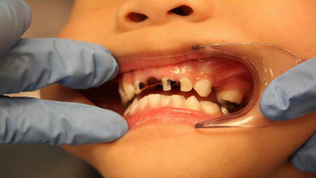 More than one-third of NSW children aged five to 10 have decay in their baby teeth. Photo: Dental Health Services Victoria
